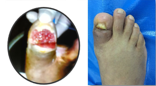 Evite amputaciones en pie diabetico