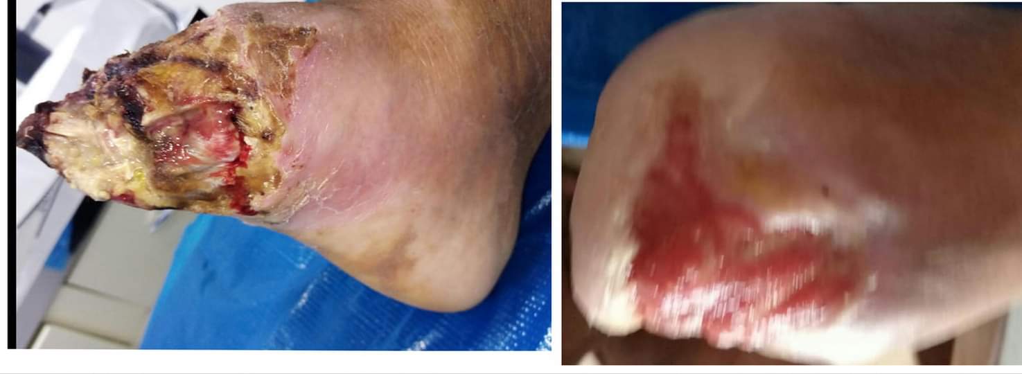 PIE DIABÉTICO: Importante evitar amputaciones